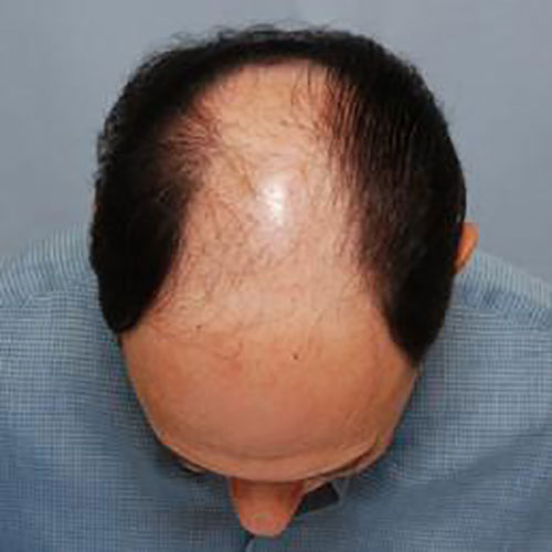 men-hair-loss--3431.jpg