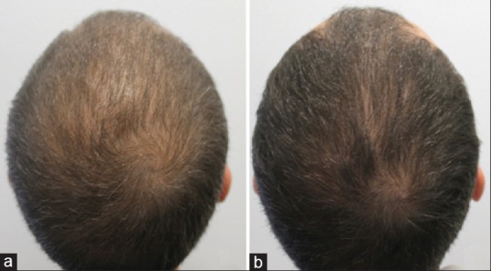 how does minoxidil affect hair growth