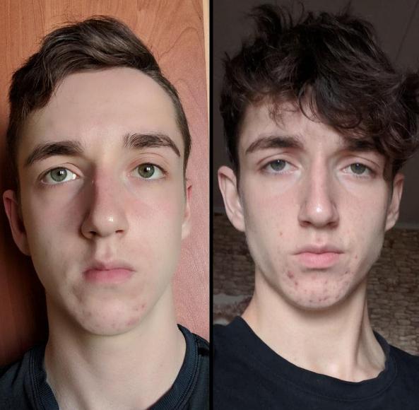 mewing-before-after-result-age-17.jpg