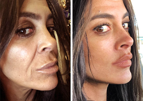 mini-facelift-patient-before-and-after.jpg