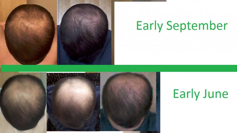 Results After Stopping minoxidil (and Losing Hair) Then Restarting (interesting Pics) HairLossTalk Forums