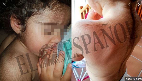 minoxidil oral in babies.JPG