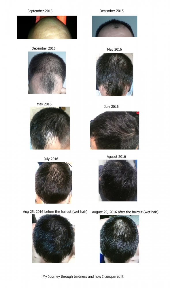My journey thru baldness.jpg