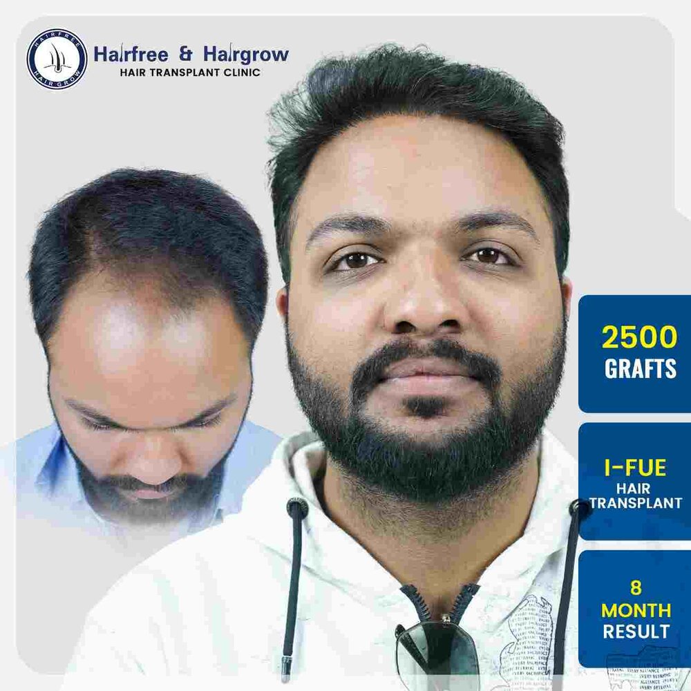 nilesh-gorde-2500-grafts-hair-transplant-8-month-result-pune.jpg-50kb.jpg