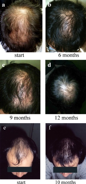nizoral-hair-loss-case-study.jpg