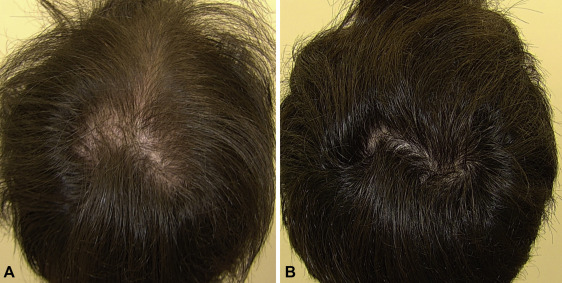 Oral-minoxidil-male-before-after-3-months.jpg