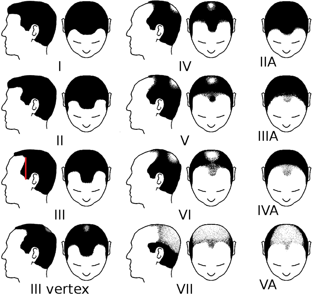 Partial_Norwood_scale_for_male_pattern_baldness.png