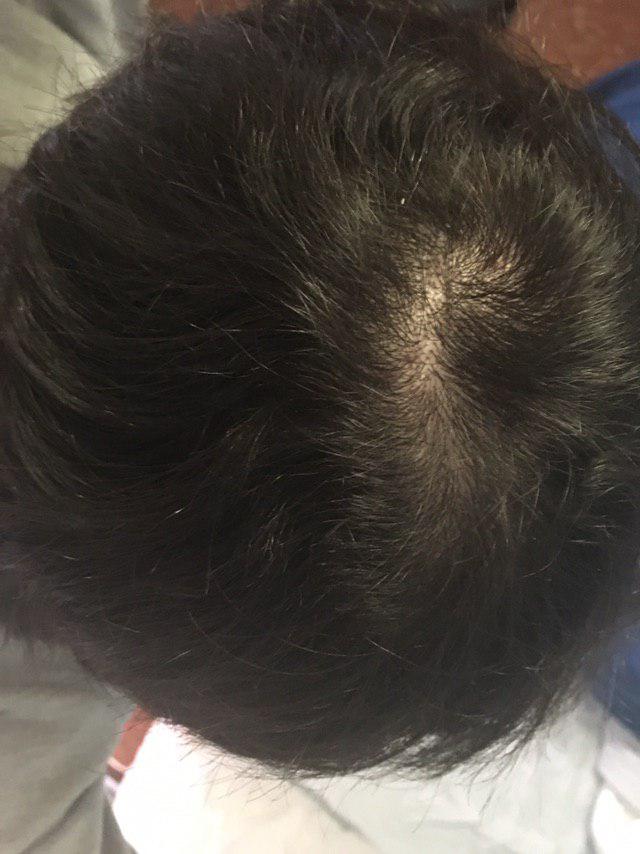 Am I Going Bald Or It's Just The Cowlick? | HairLossTalk Forums