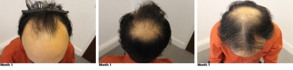 Finasteride (propecia) Regrow Hair On Its Own Or Need To Use Minoxidil Too?  | HairLossTalk Forums