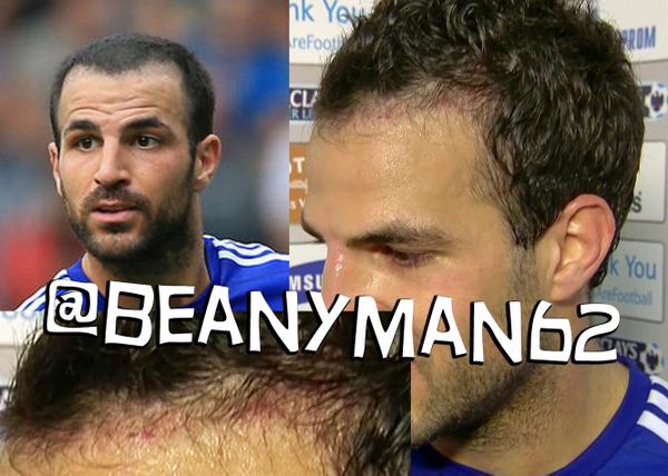 php?image=http%3A%2F%2Fwww.101greatgoals.com%2Fwp-content%2Fuploads%2F2014%2F10%2Fhairtransplant.jpg