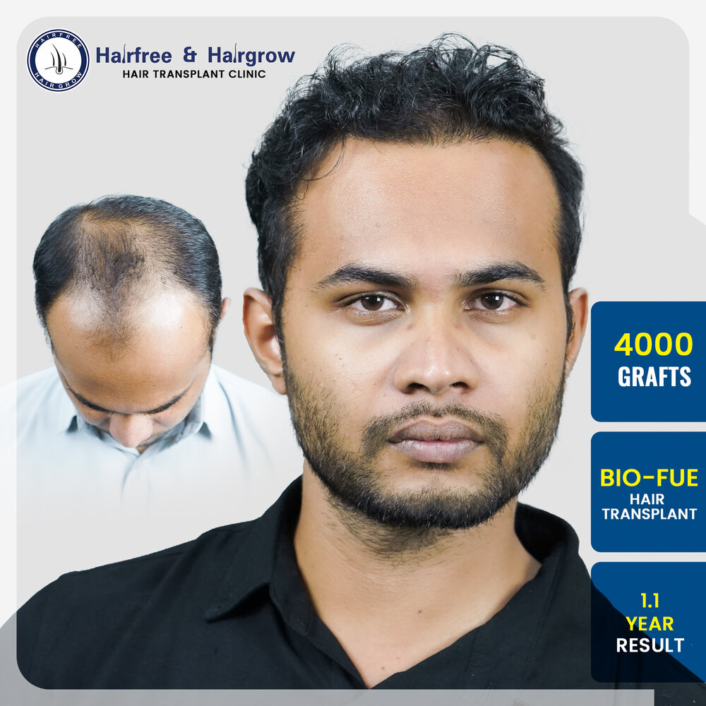 prashant-more-4000-grafts-hair-transplant-1-year-before-after-result-pune.jpg.jpg