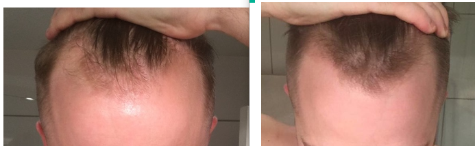 2 Months Progression With Minoxidil HairLossTalk Forums