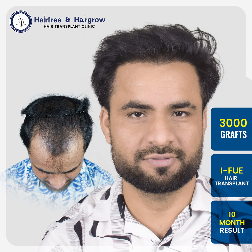 rahul-jagga-3000-grafts-hair-transplant-10-month-before-after-result-pune.jpg.jpg