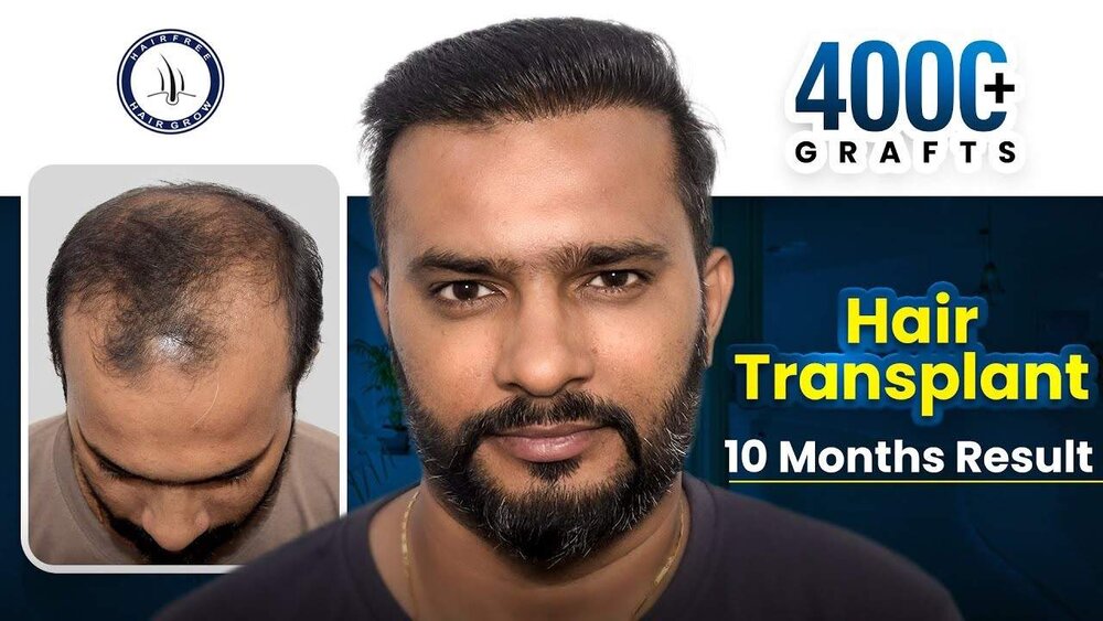 Rahul Makwana Hair Transplant Success Story.jpeg