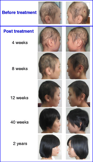 Regrowth-of-hair-following-Stem-Cell-Educator-therapy-A-subject-with-severe-AA-patient.jpg