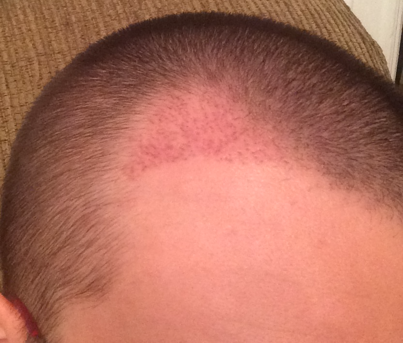 Right Side TP1 3 weeks.png