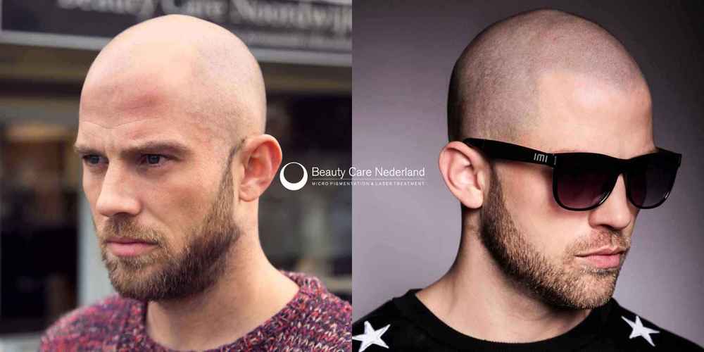 Scalp-Micro-Pigmentation-SMP-Beauty-Care-Nederland-BCN-large1.jpg