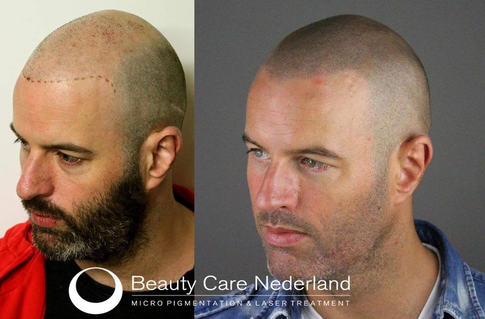 Scalp-Micro-Pigmentation-SMP-Beauty-Care-Nederland-BCN-large3.jpg