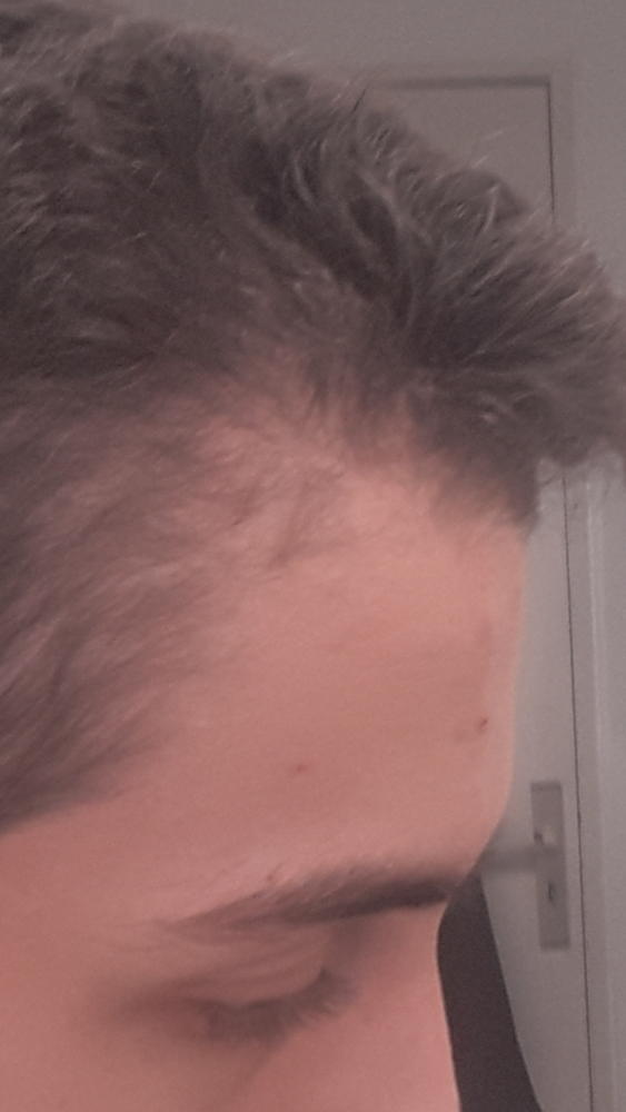 17year Old) Cowlick Or Receding Hair? | HairLossTalk Forums