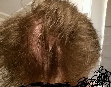 is too much minoxidil bad