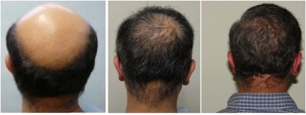 severe-hair-loss-1.jpg