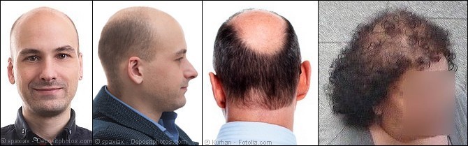 skull-expansion-hair-loss-exercises-male-and-female-hair-loss-nHFuSE.jpg