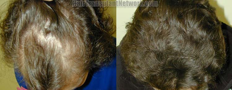 surgical-hair-replacement-images-top-163931.jpg
