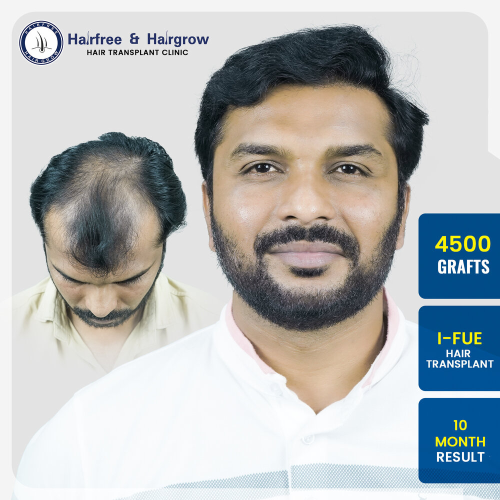swapnil-badnale-4500-grafts-i-fue-hair-transplant-10-month-result-pune.jpg.jpg