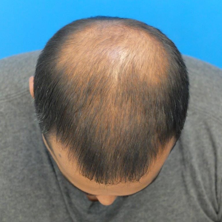topical-finasteride-after-6-months.jpg