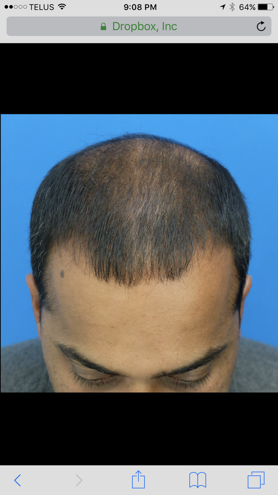 topical-finasteride-results-after-9-months-2.png