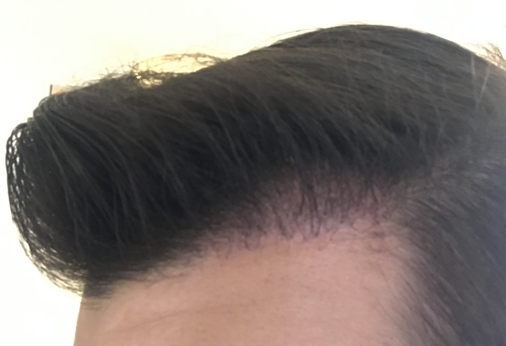 TP3 left side 2.5 months.png