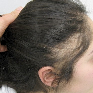 traction-alopecia-photo-woman.jpg?width=370&height=370&center=0.5,0.jpg