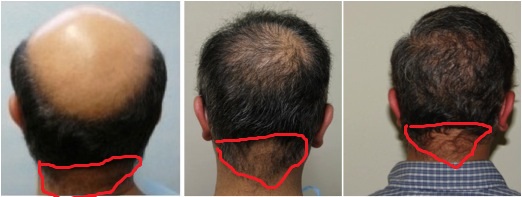 treatment-for-severe-baldness-5.jpg