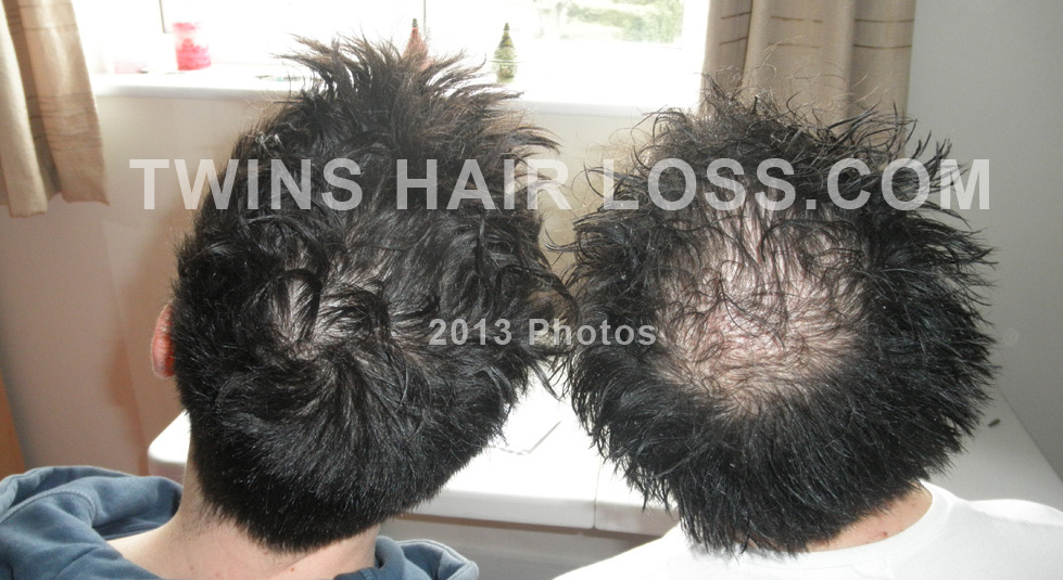 twins-hair-loss-comparison-photo-12.jpg