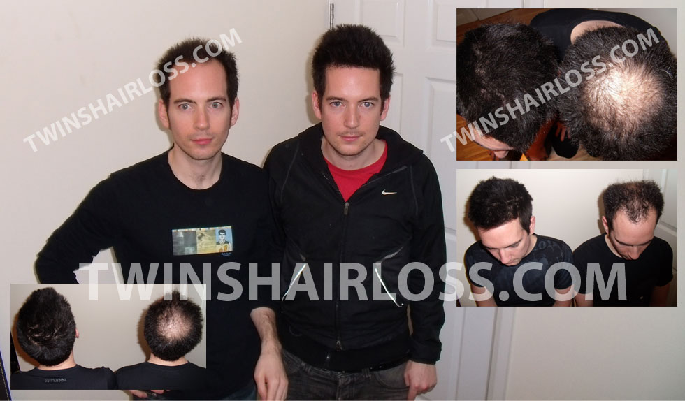 twins-hair-loss-main-photo.jpg
