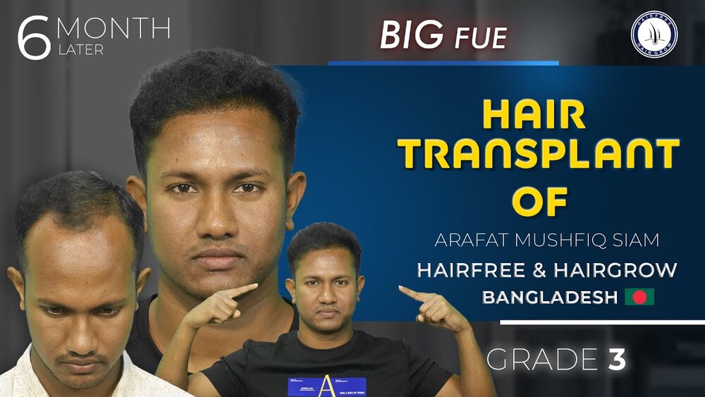 Unbelievable Hair Transplant Results.jpg