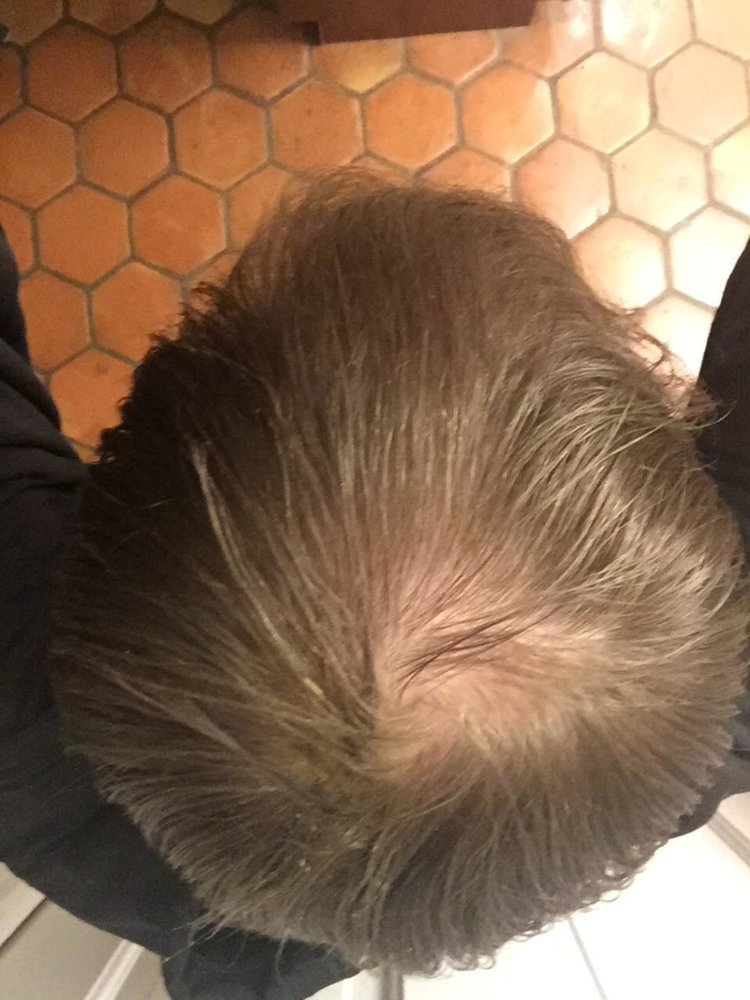 Is My Crown Balding Or Is It Just Naturally Like That