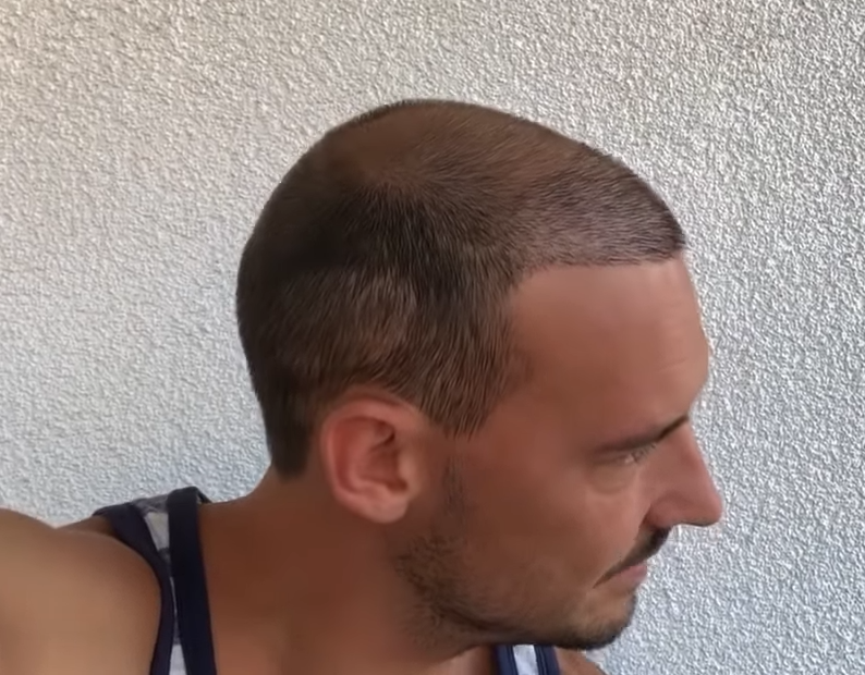 A Buzzcut Is Really Unforgiving When You Start To Lose Density |  HairLossTalk Forums