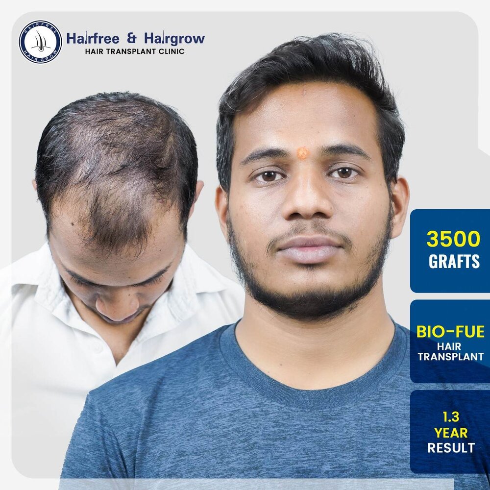 vaishanv-bhagade-3500-grafts-bio-fue-hair-transplant-1-3-year-result-pune.jpg-200kb.jpg
