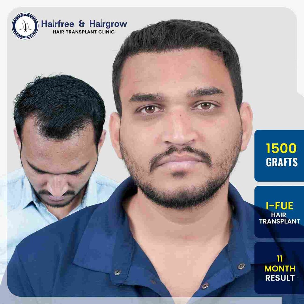 vinayak-gaikwad-1500-grafts-i-fue-hair-transplant-11-month-result-pune-50kb.jpg