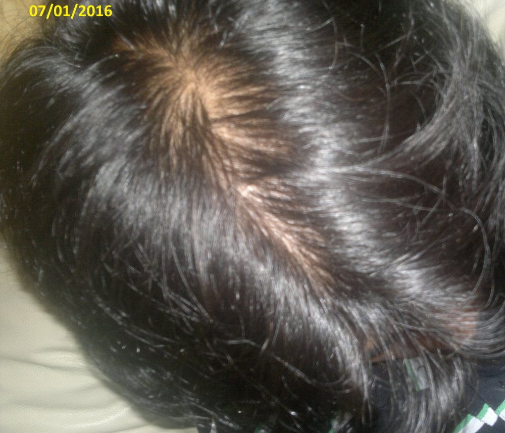Hair Loss Greasy Itchy Scalp Painful Hair Roots HairLossTalk