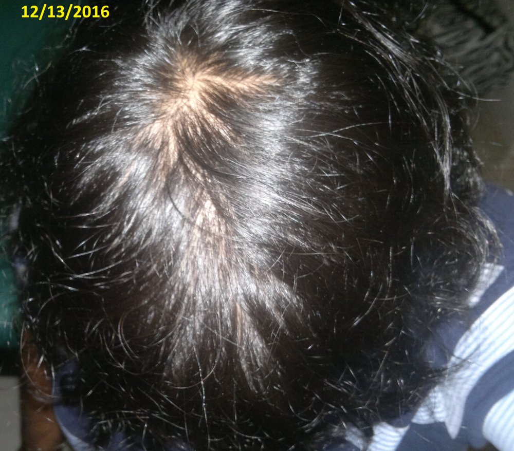 Hair Loss Greasy Itchy Scalp Painful Hair Roots HairLossTalk