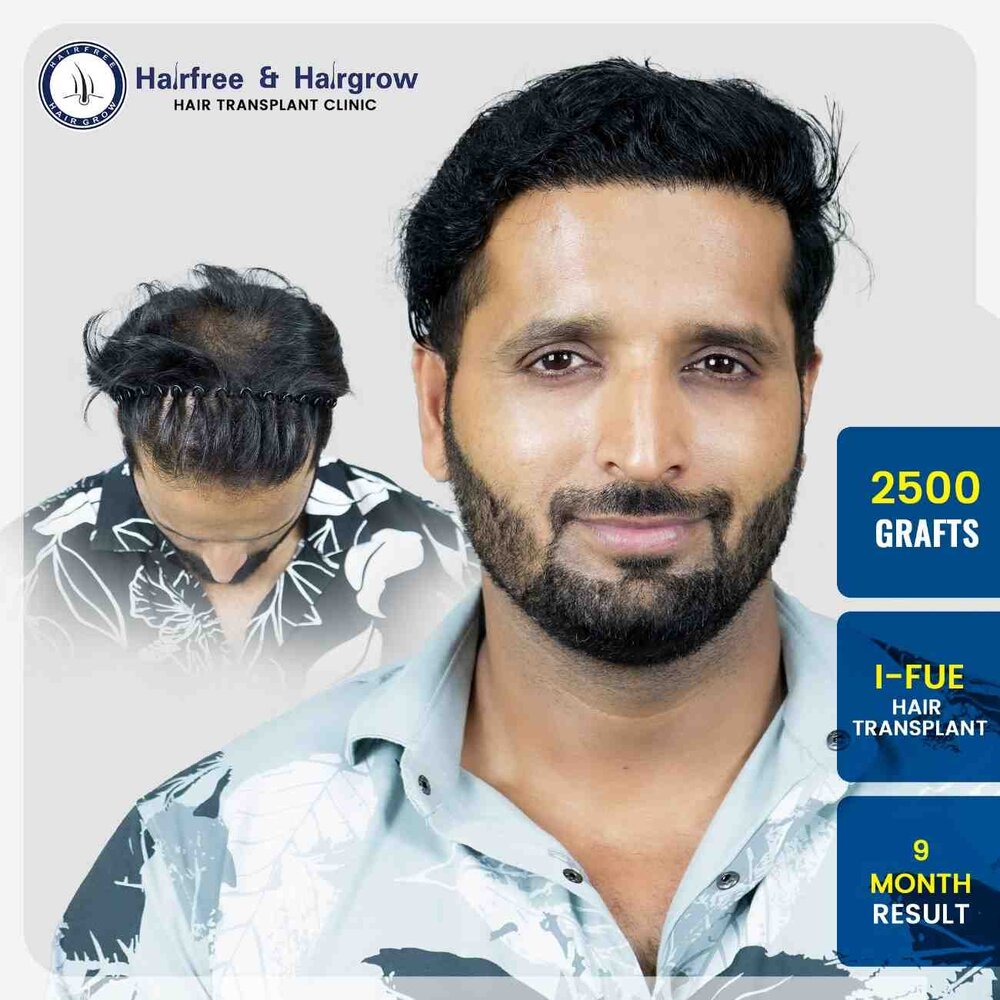wasim-hongekar-2500-grafts-i-fue-hair-transplant-9-month-result-pune.jpg-82kb.jpg
