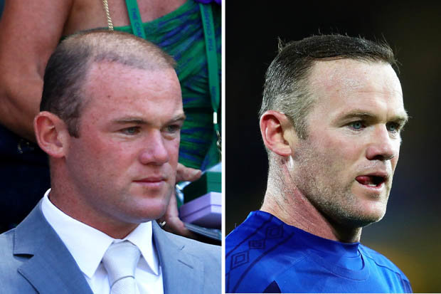 Wayne-Rooney-hair-transplant-before-and-after.jpg