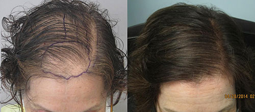 womens-hair-transplant-los-angeles5.jpg