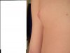 .Right Pec..JPG