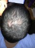 Hairloss August 2013.jpg