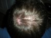 Hairloss March 2009.jpg