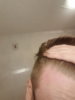 hairline left temple 2.jpg