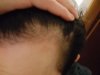 Before; hairline.jpg